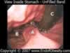Stomach endoscopy Unfilled Lap Band